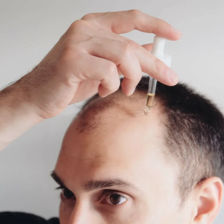 man applying redensyl to hair to improve hair loss