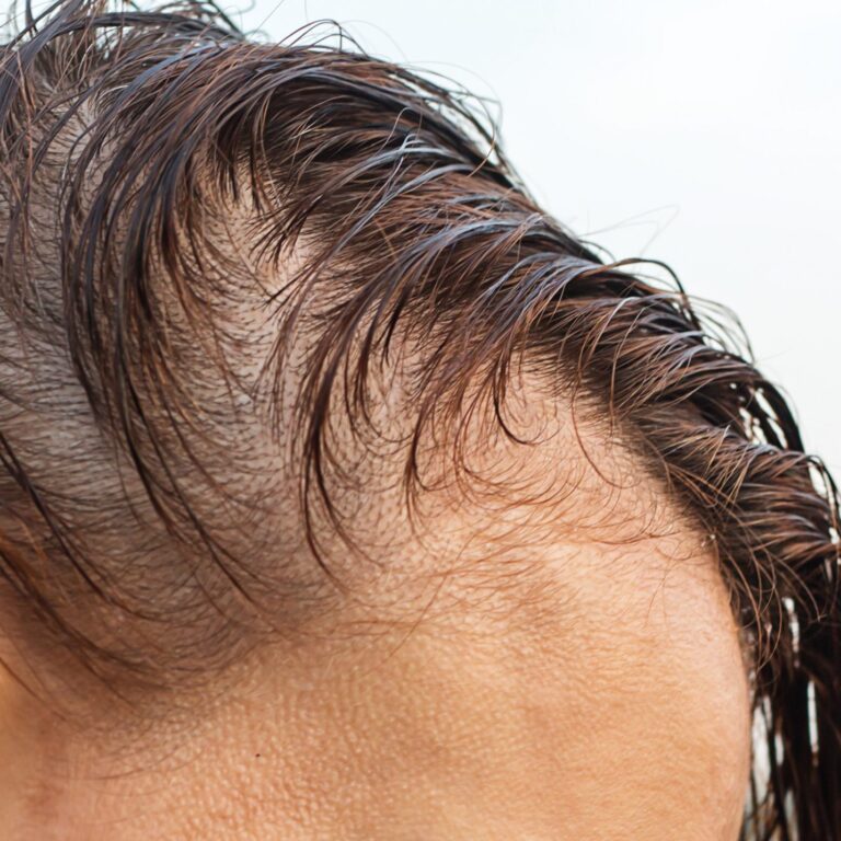 SCUBE3 and Osteopontin for the treatment of hair loss