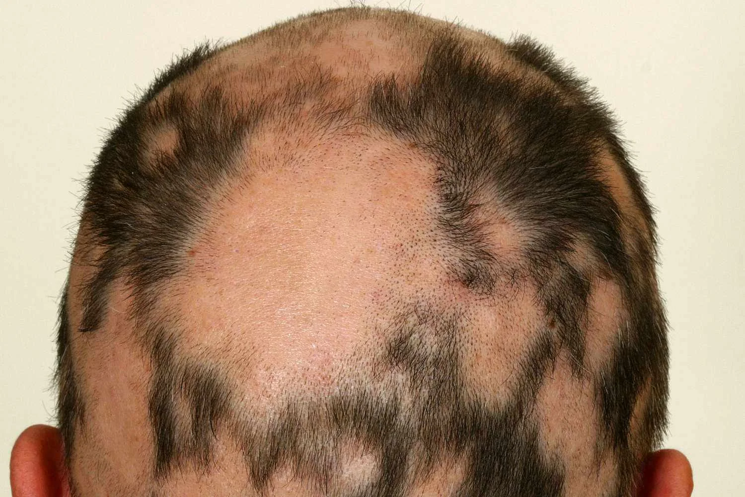 Close up of mans head showing alopecia areata hair loss