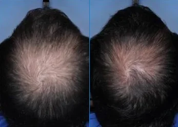 Close up showing before and after results of using cb-03-01 (Clascoterone) to treat hair loss