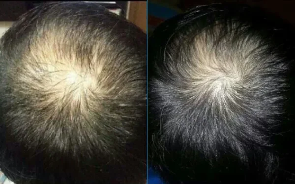 Before and after results of using essential oils (rosemary oil) to treat hair loss