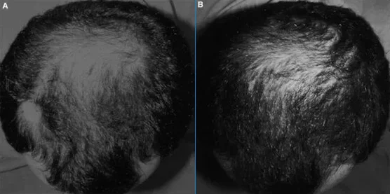 Close up showing the before and after results of using Fluridil to treat hair loss and balding Non-FDA Approved