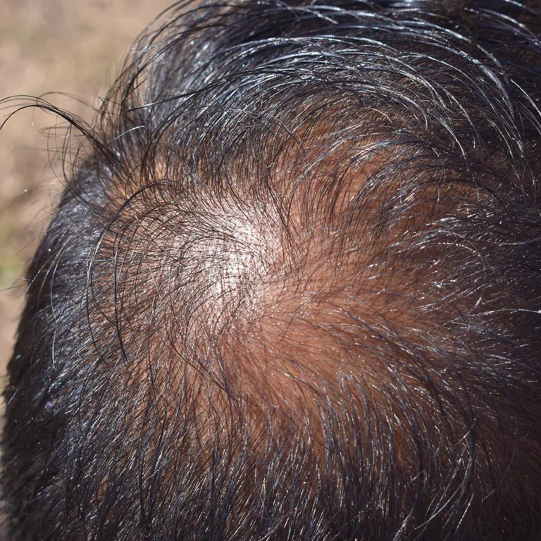 Close up of baling scalp showing hair follicle miniaturization