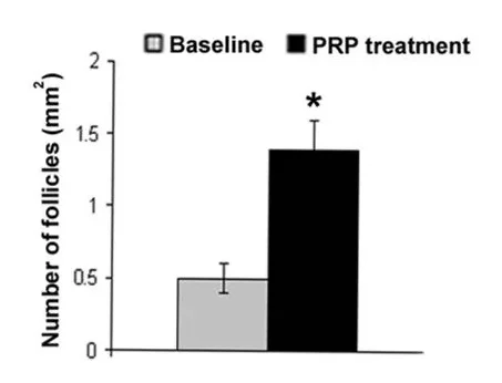 Clinical trial results of using platelet-rich plasma (PRP)