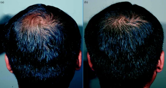 Close up of head showing the before and after results of using Procyanidin B2 to treat hair loss