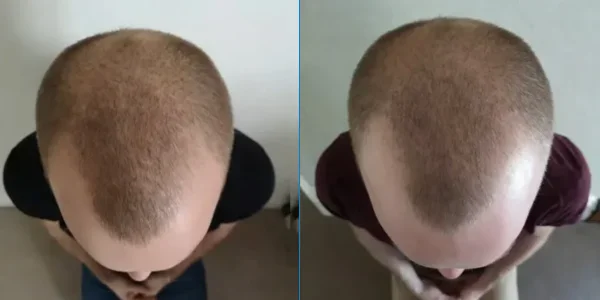 Before and after showing the results of scalp massages