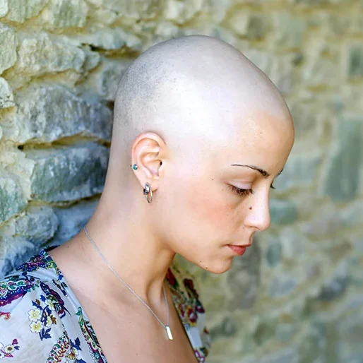 Profile of women showing showing alopecia totalis hair loss