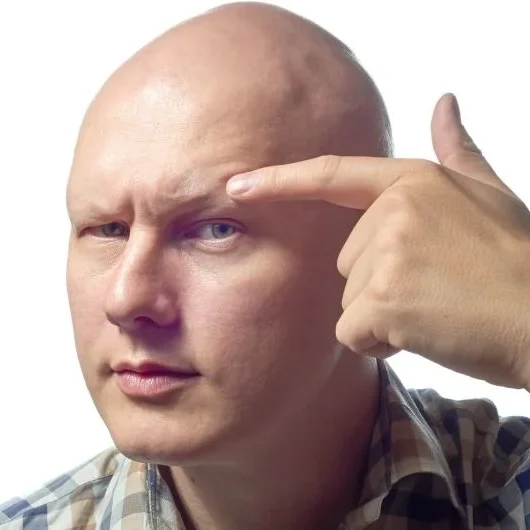 mans head showing alopecia universalis