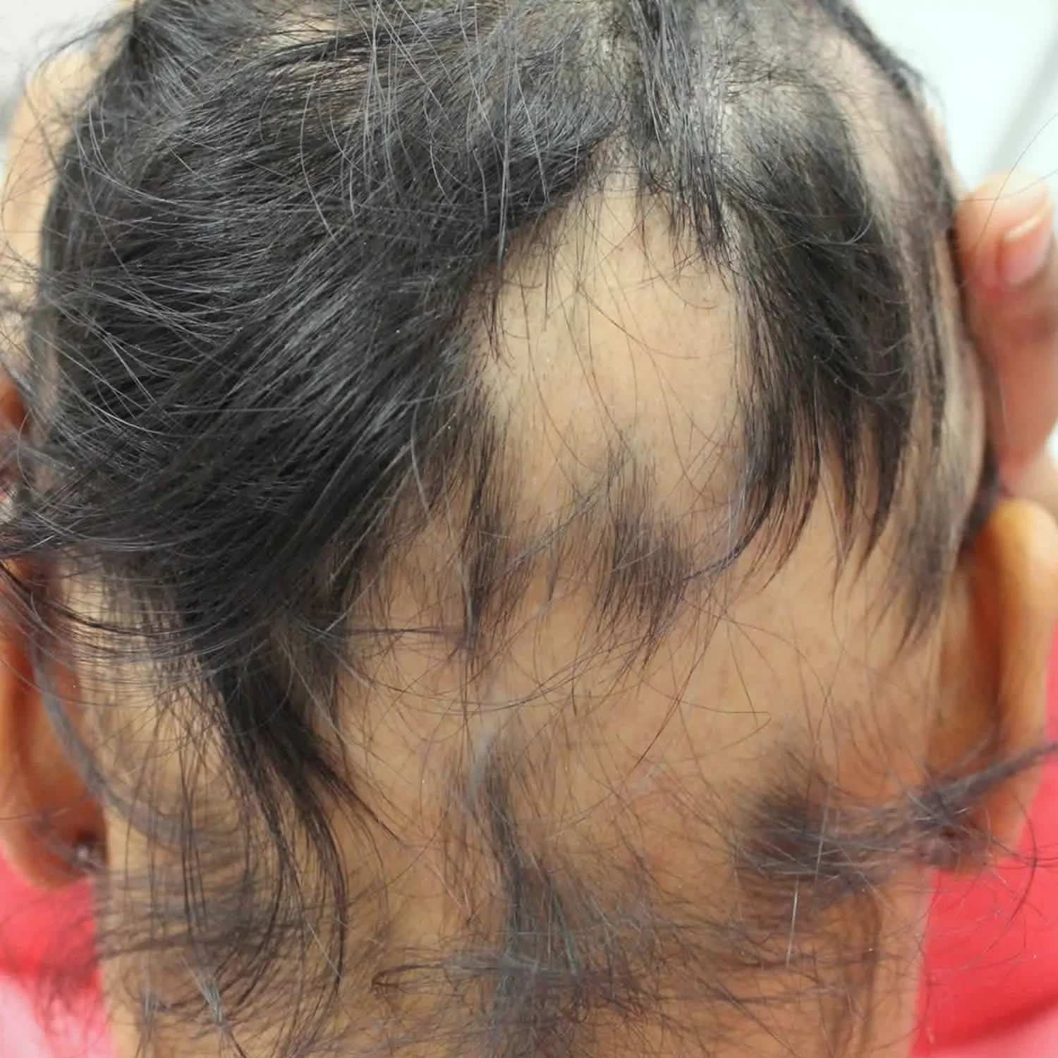 Close up of scalp showing anagen effluvium hair loss