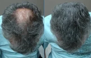 Close up of showing before and after results of using Ketoconazole to treat hair loss and balding