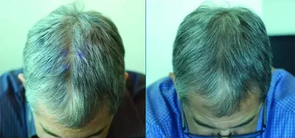 Before and after showing the results of using green tea to treat hair loss