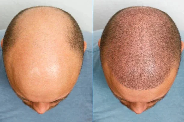 Before and after results of hair transplant surgery to regrow a full head of hair