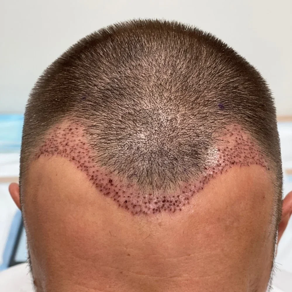 Close up showing the results of a hair transplant after the surgery at Hairloss-Recovery