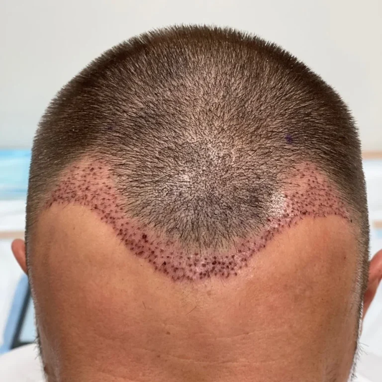 Close up showing the results of a hair transplant after the surgery at Hairloss-Recovery