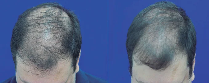 Close up showing the before and after results of using latanoprost to treat hair loss and balding