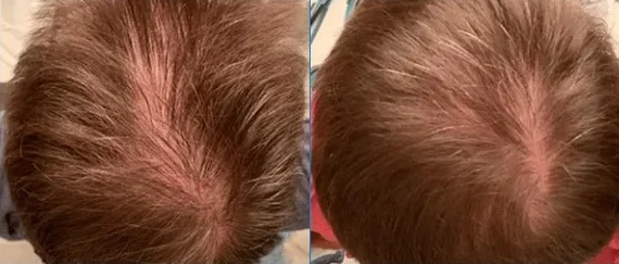 Before and after of hair growth with low-level laser therapy (LLLT) for hair loss treatment