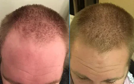 Close up showing before and after results dermarolling (microneedling) and minoxidil to treat hair loss Non-FDA Approved