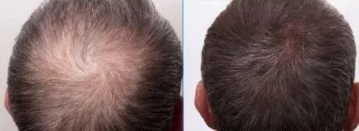 Before and after using platelet-rich plasma (PRP) to treat hair loss