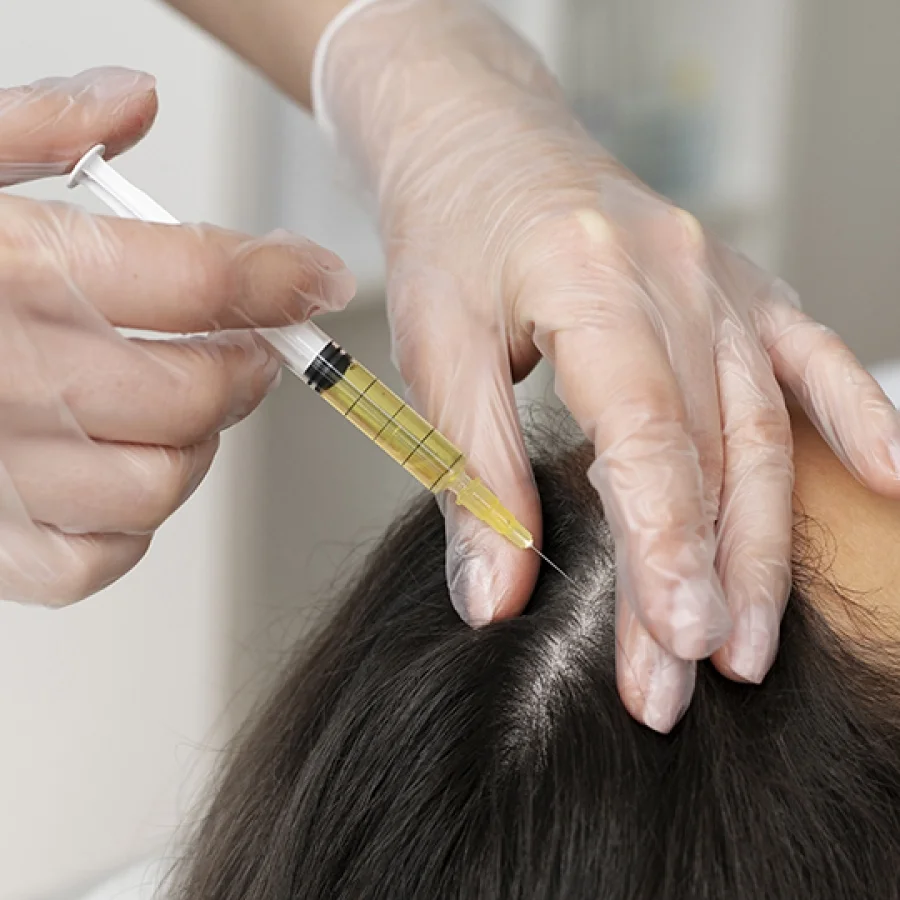 Close up injecting platelet rich plasma (PRP) as an FDA approved treatments for hair loss for androgenetic alopecia