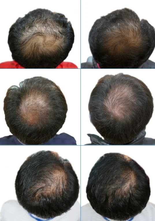 Before and after results of using pumpkin seeds to treat hair loss