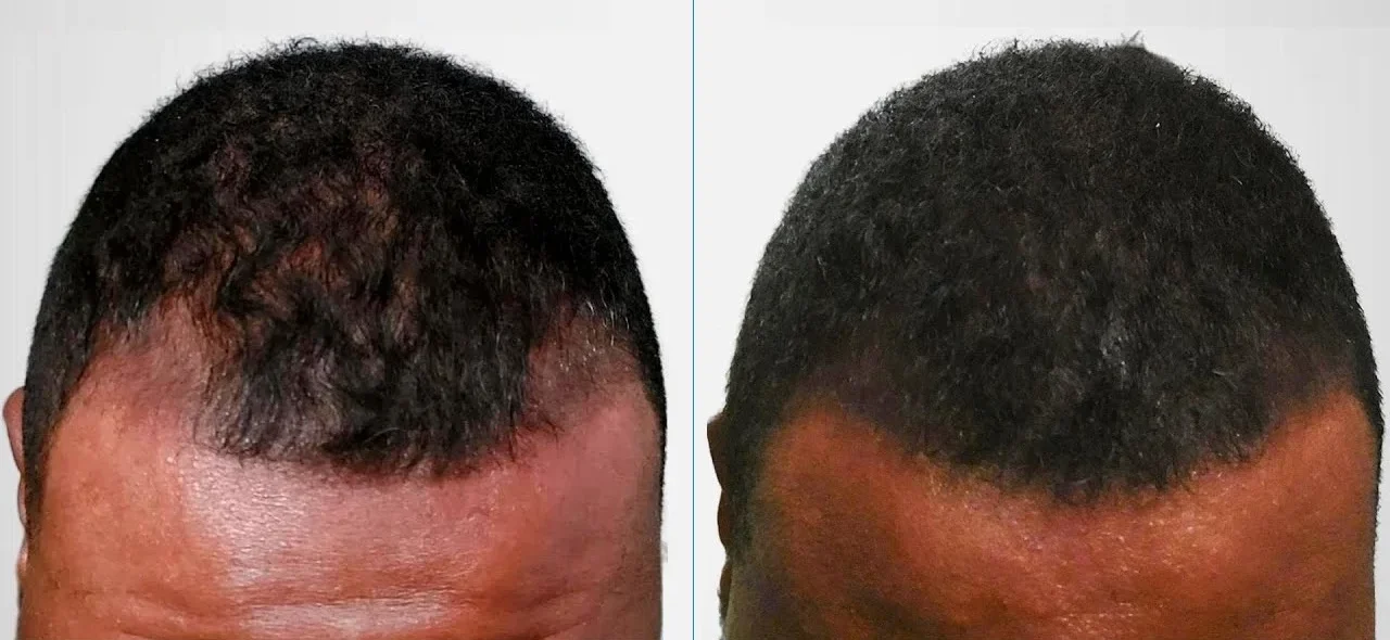 Close up showing the before and after results using pyrilutamide to treat hair loss and balding