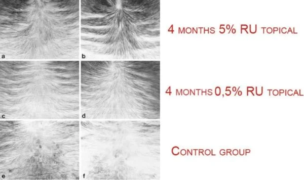 Close up of scalp showing the before and after clinical trial results of using RU-58841 for treating hair loss and balding