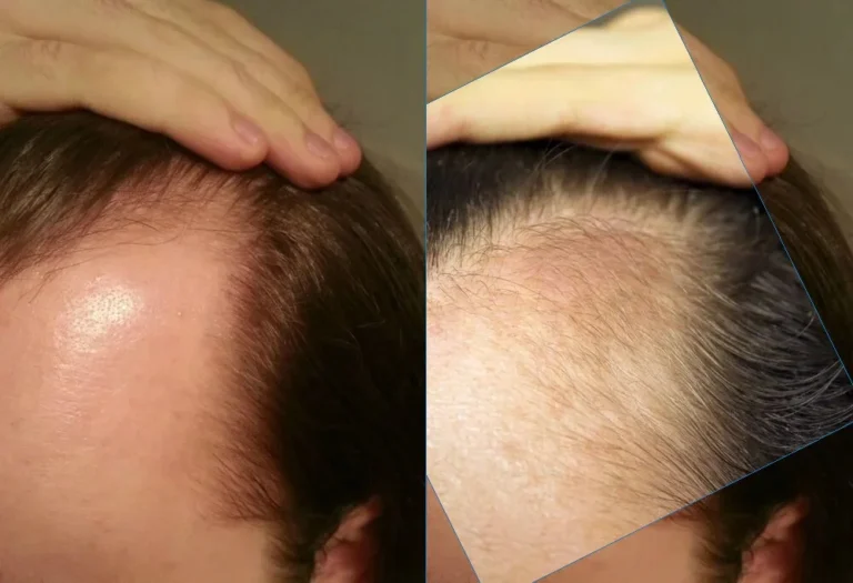 Before and after using setipiprant and pge2 to regrow hair on balding temples Non-FDA Approved