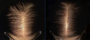 Close up showing the before and after results of using spironolactone to treat hair loss and balding