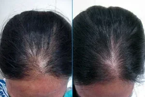 Close up showing the before and after results of using Stemoxydine to treat hair loss and balding