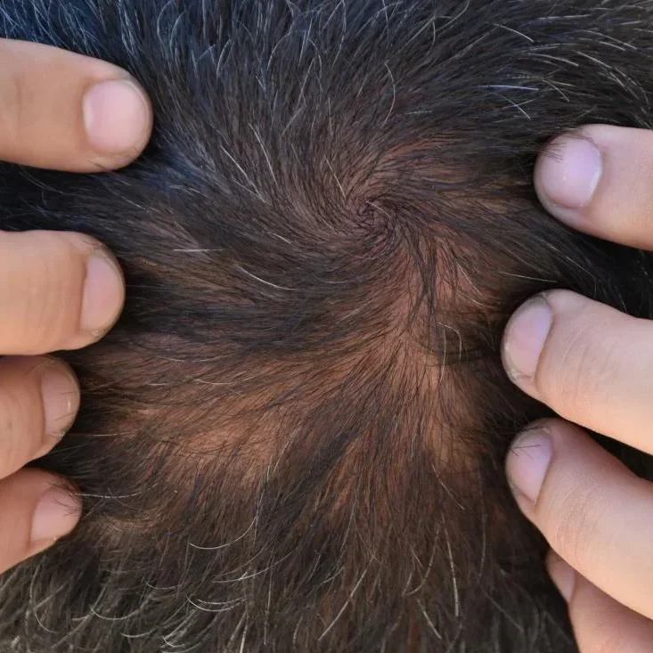 Close up of scalp showing telogen effluvium hair loss