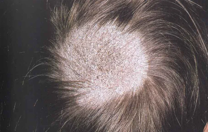 Early diagnosis, treatment key to prevent permanent baldness in tinea  capitis