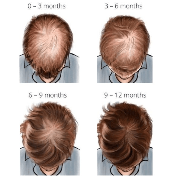 hair loss treatment timelines to see results