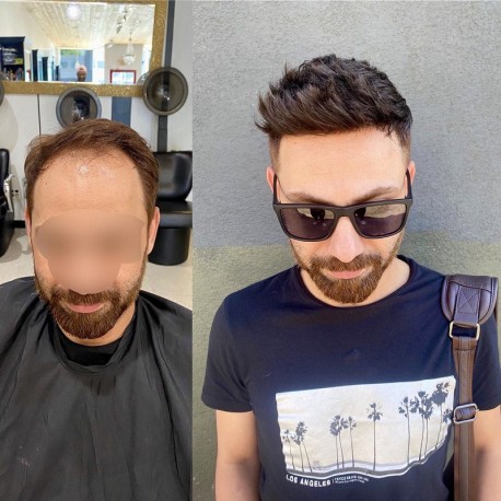 man wearing a hair system to treat his hair loss