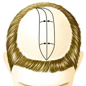 Diagram showing how the scalp reduction surgery works