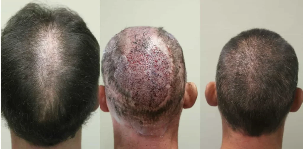 before, during, and after scalp reduction surgery