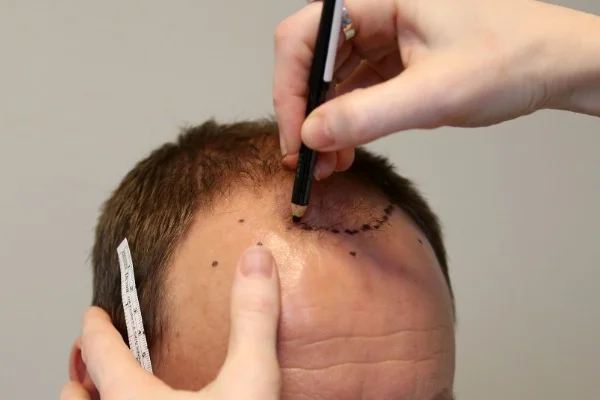 man getting consultation from a qualified professional for scalp reduction surgery