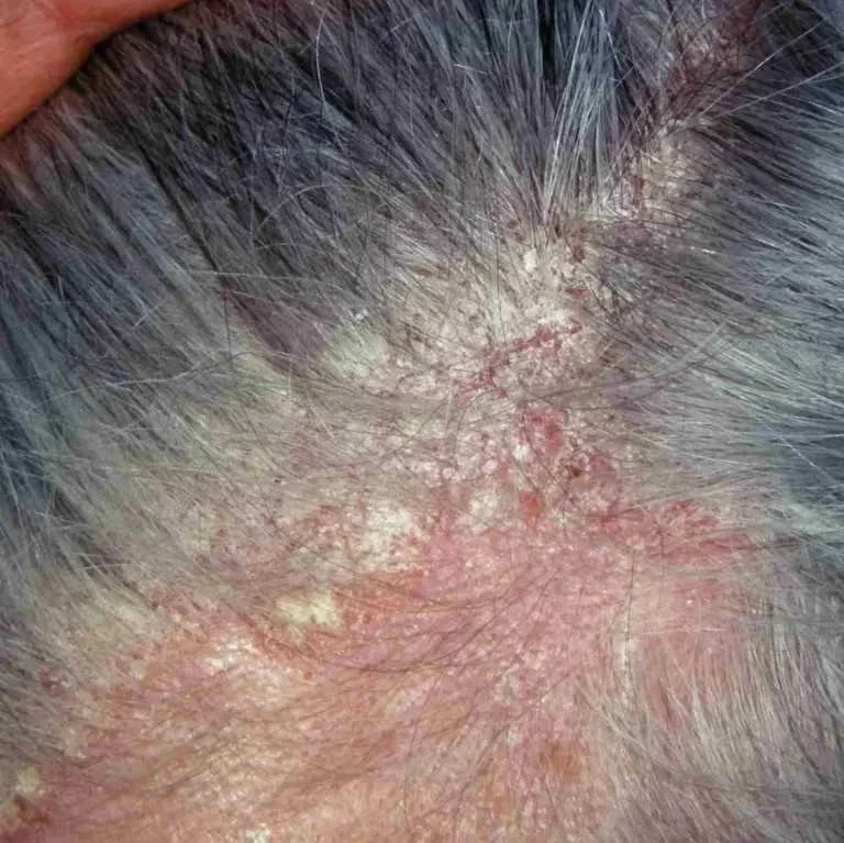 Close up of scalp with seb derm