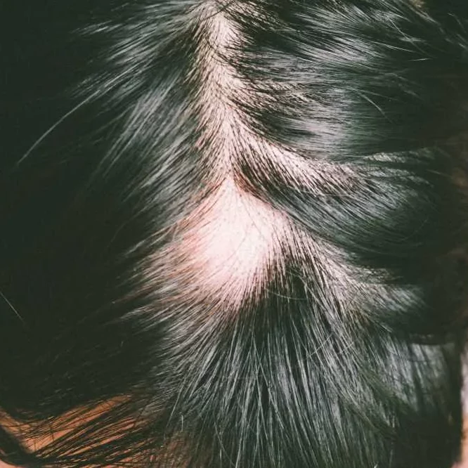 Close up of head showing Cicatricial Alopecia hair loss