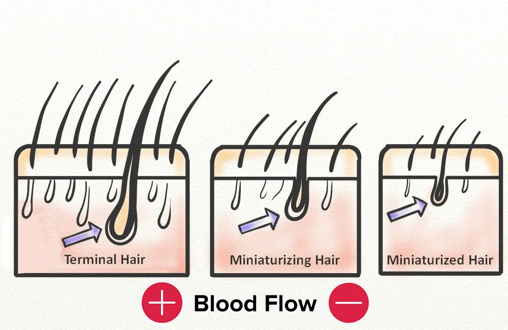 decreased blood flow leading to hair loss