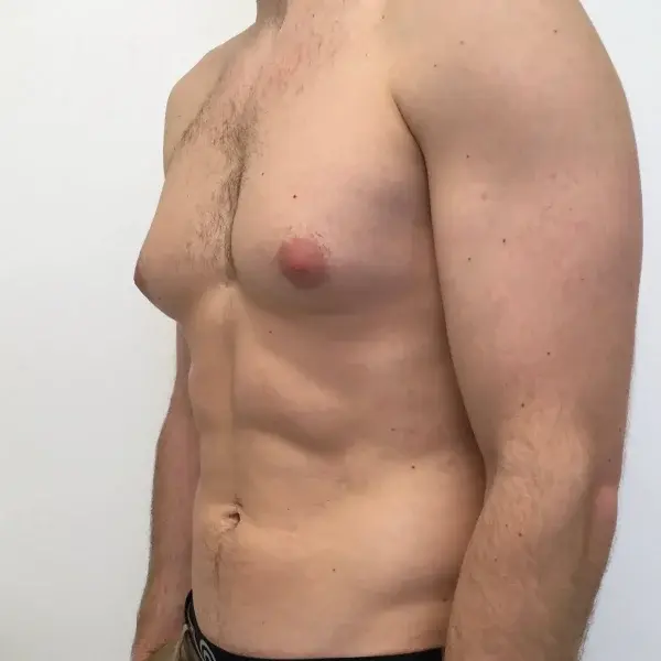 gynecomastia (gyno) from finasteride