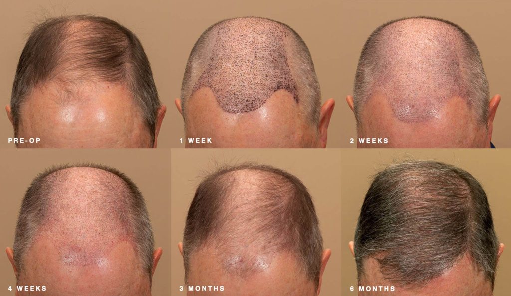 hair transplant at the various recovery stages up to 6 months