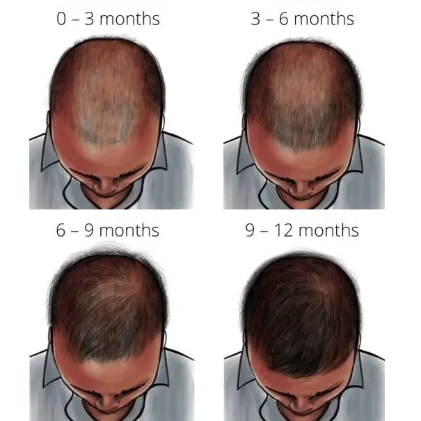 timeline results for treating hair loss on finasteride