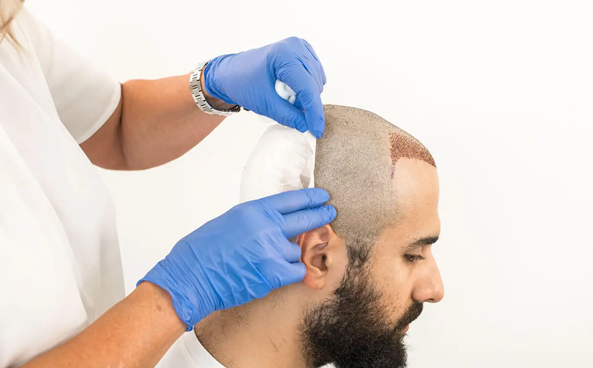 Post-hair transplant care to manage donor area shock loss