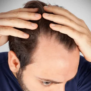 man shows symptoms of male pattern baldness
