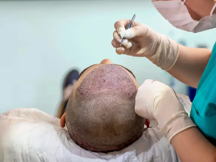 hair transplant surgery with donor shock area hair loss