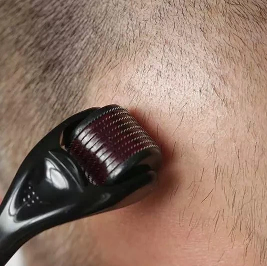 microneedling on bald scalp