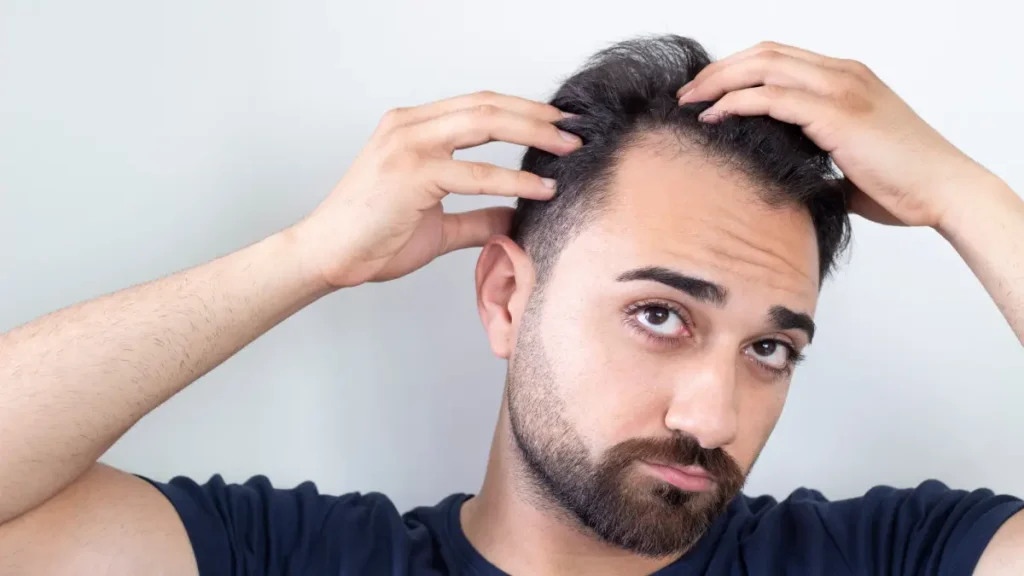 hair loss in young adult
