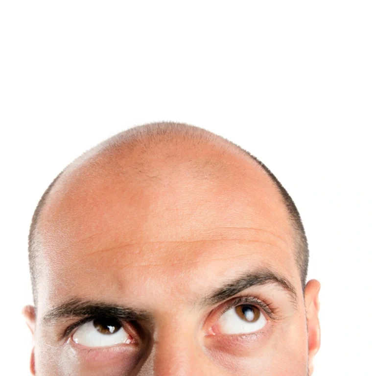 hair loss myths vs. facts