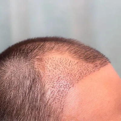 example of donor area shock loss after hair transplant