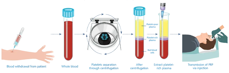 platelet-rich-plasma-PRP-procedure